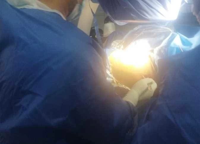 نجاح تدخل جراحي لعلاج كسر مفتت بعظام الوجنة ومحجر العين بمستشفى أجا في الدقهلية