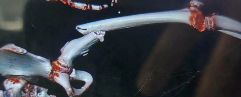 تدخل جراحي عاجل ينقذ حياة طفل عمره 12 عامًا في القليوبية