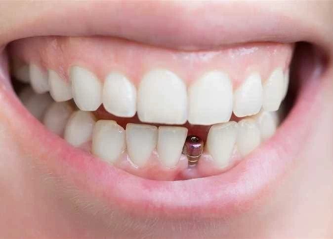 لماذا تفشل المضادات الحيوية في علاج التهابات زراعة الأسنان؟